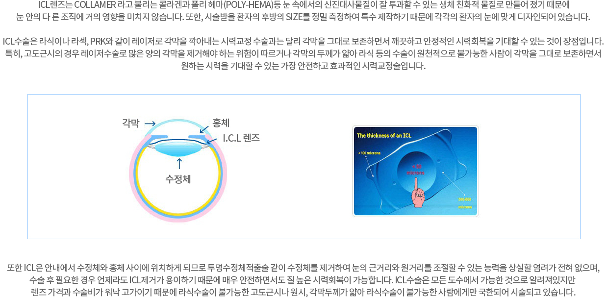 ICL ̳ , PRK    Ƴ ÷±  ޸  ״ ϸ鼭 ϰ  ÷ȸ   ִ  Դϴ. Ư, ٽ      ؾ ϴ  ų  β     õ Ұ   ״ ϸ鼭 ϴ ÷   ִ  ϰ ȿ ÷±Դϴ.